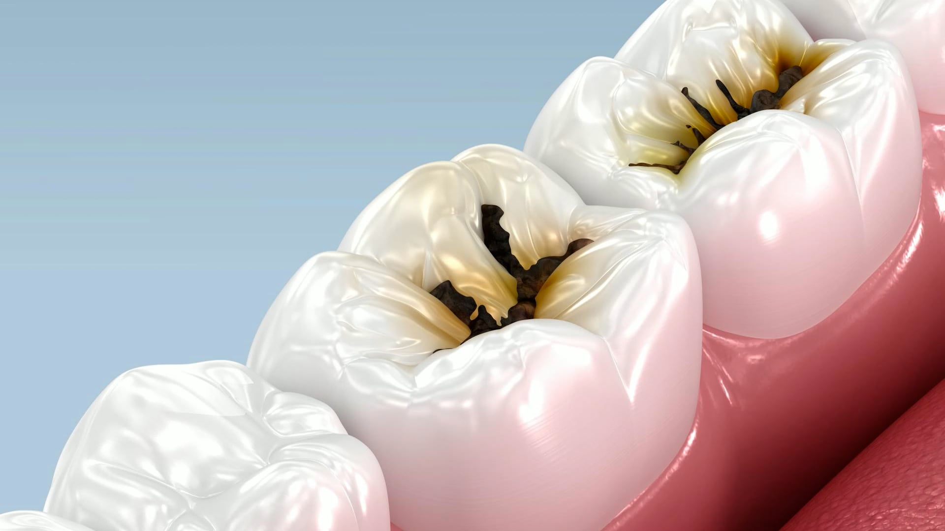 Can you actually reverse tooth cavities at home?