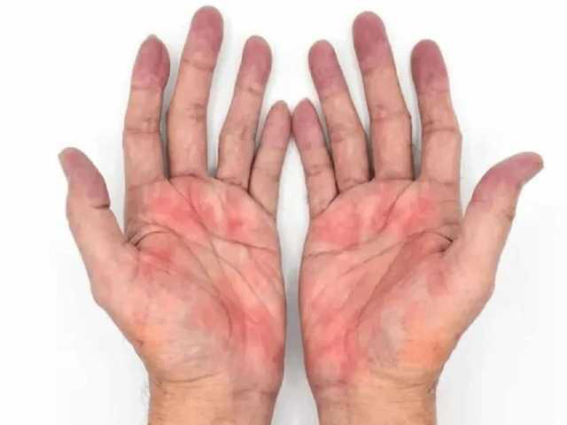 Warning signs in your palms that reveal hidden liver damage