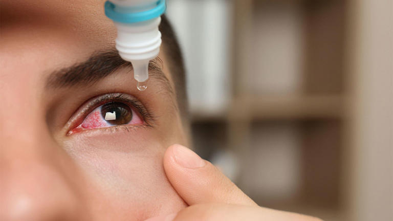 OTC alpha-agonist drops for eye redness get FDA green light
