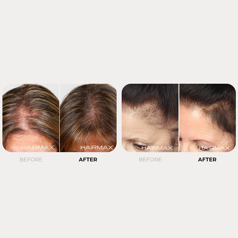 This FDA-cleared hair growth laser comb takes just 8 minutes to use