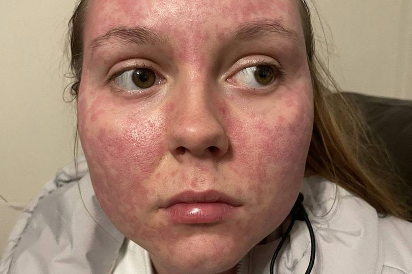 'Doctors thought my goldfish were causing my pizza rash - but my own ...