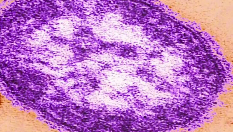 VDH investigating confirmed measles case in Harrisonburg