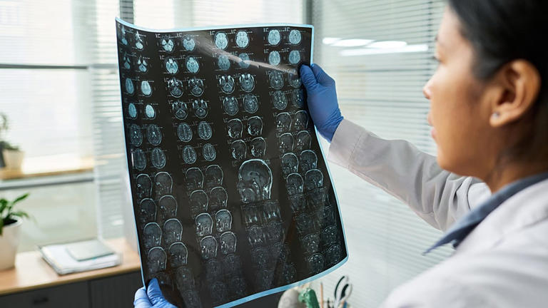 Researchers use ChatGPT-style technology to predict stroke risk from a ...
