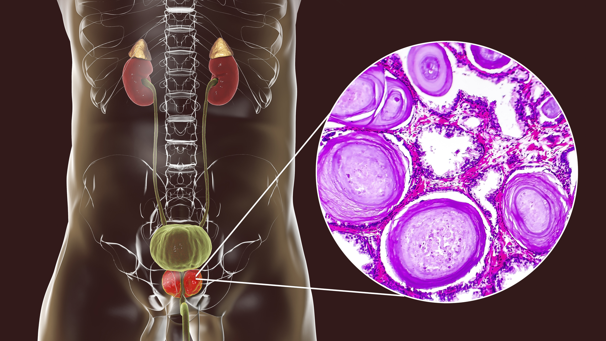 Prostate cancer deaths are finally on the decline – the breakthrough ...