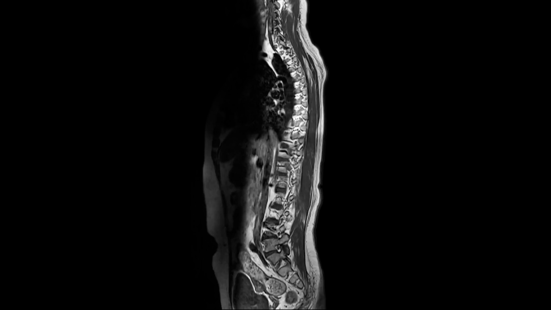 A spine surgeon explains the heavy, tired leg feeling caused by spinal ...
