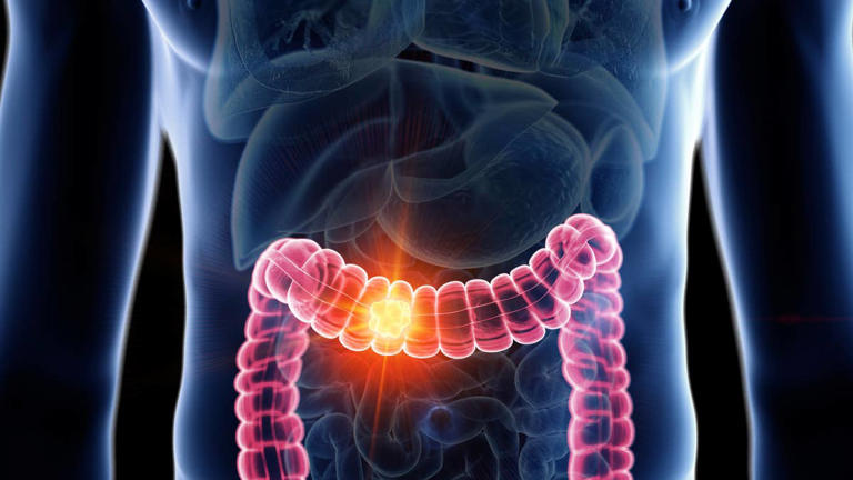 Colon cancer survivor warns young people to watch out for this early ...