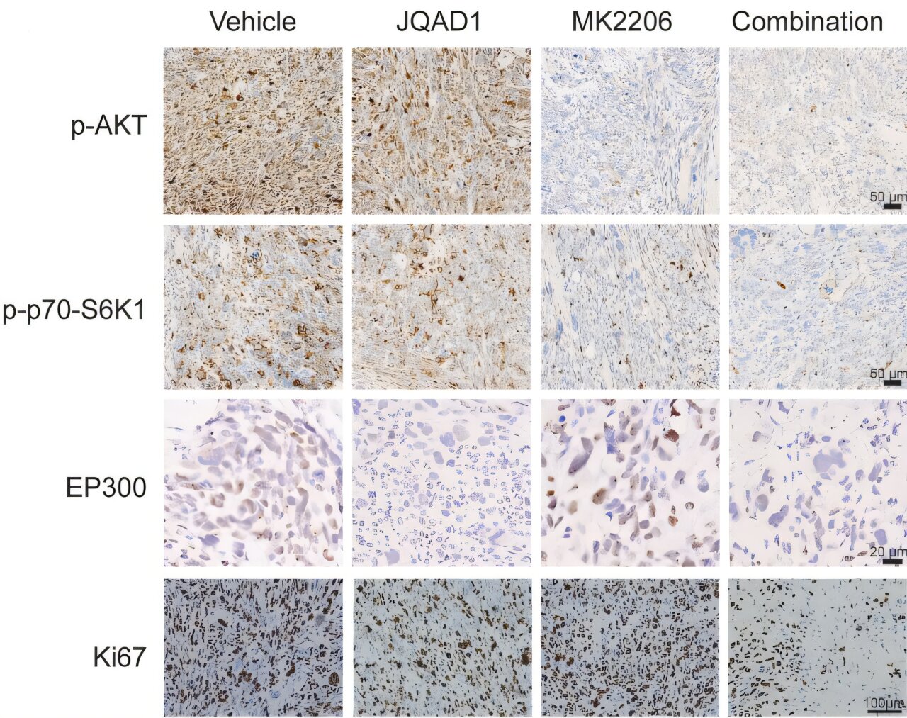 Combination therapy reveals potential vulnerability in aggressive ...