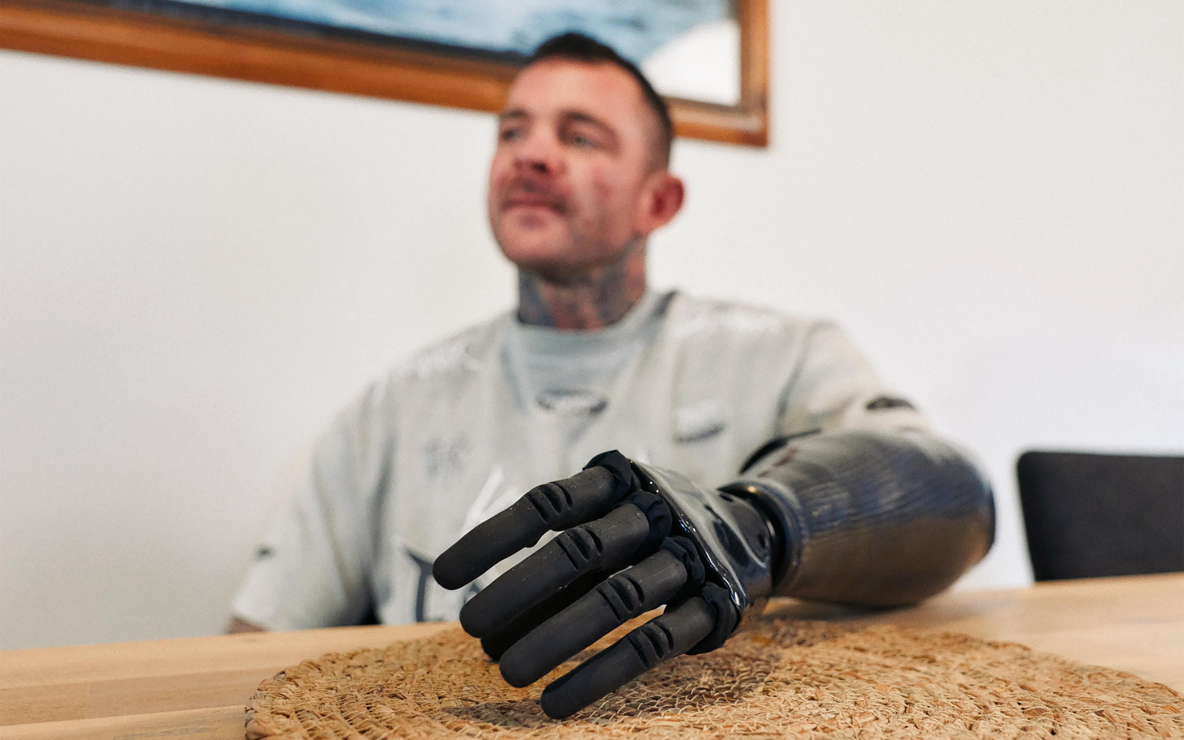 Under-skin implant controls prosthetic arms