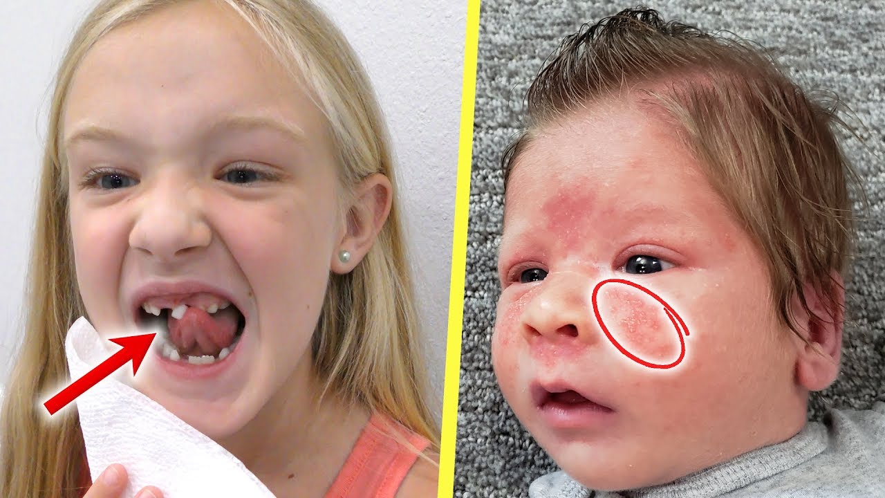 Trinity loses her tooth and Preston's rare baby skin rash!