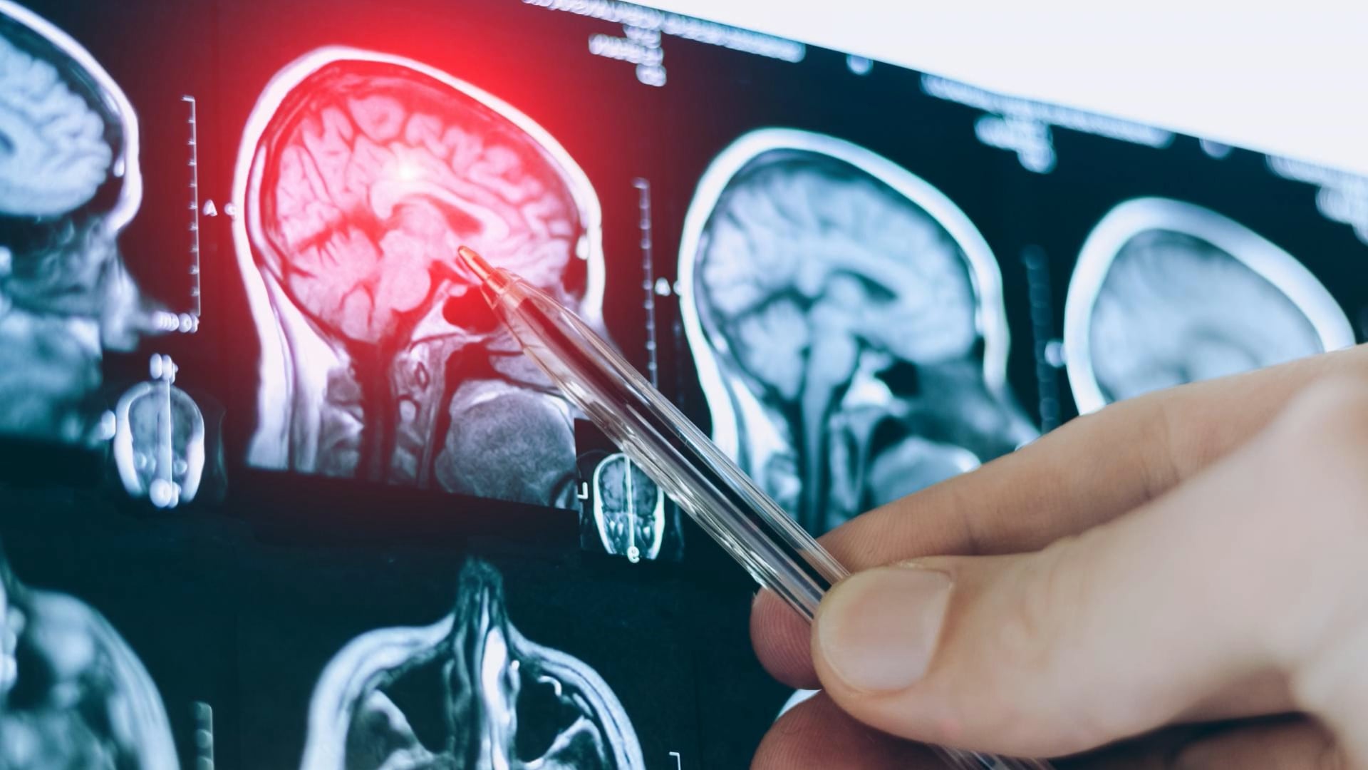 How to stop brain shrinkage after 50