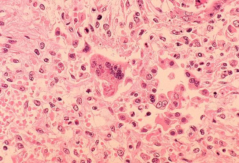 Pa. warns of measles infections among pregnant women and congenital cases