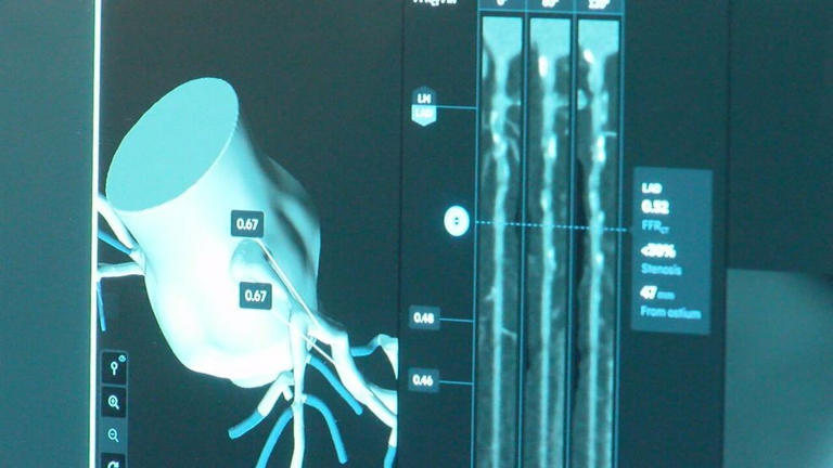 Batavia hospital debuts AI-powered technology meant to improve heart care