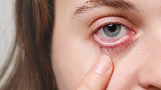 Eye injury first aid: Doctor shares steps to take if dust gets in your ...