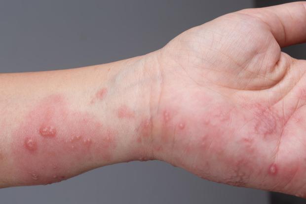 Scabies cases rise as warning issued on symptoms to look out for