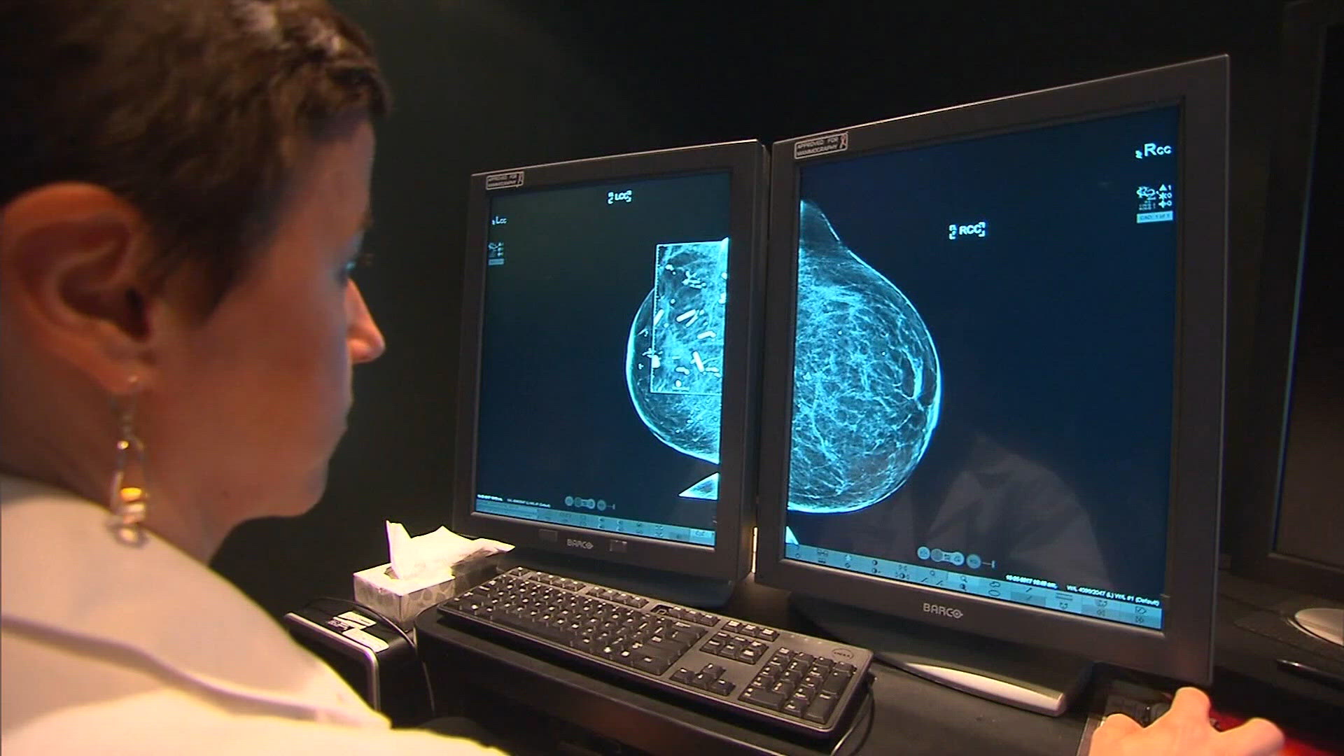 Understanding breast cancer symptoms and advances in treatment