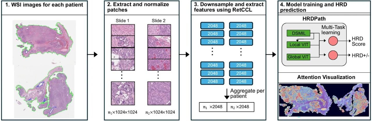 AI model detects signs of faulty DNA repair in ovarian cancer using ...