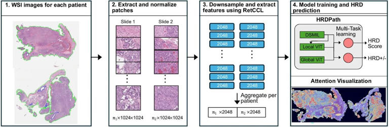 AI model detects signs of faulty DNA repair in ovarian cancer using ...