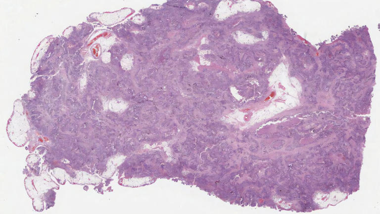 AI model detects signs of faulty DNA repair in ovarian cancer using ...