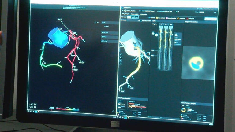 Batavia hospital debuts AI-powered technology meant to improve heart care