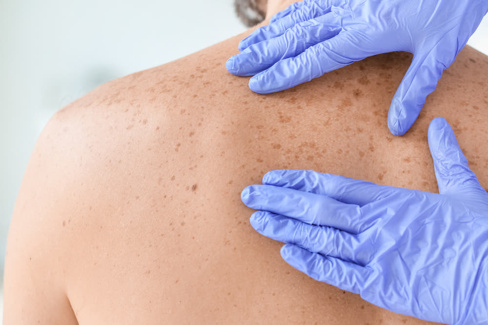 42 percent of cancer cases could be prevented through lifestyle changes