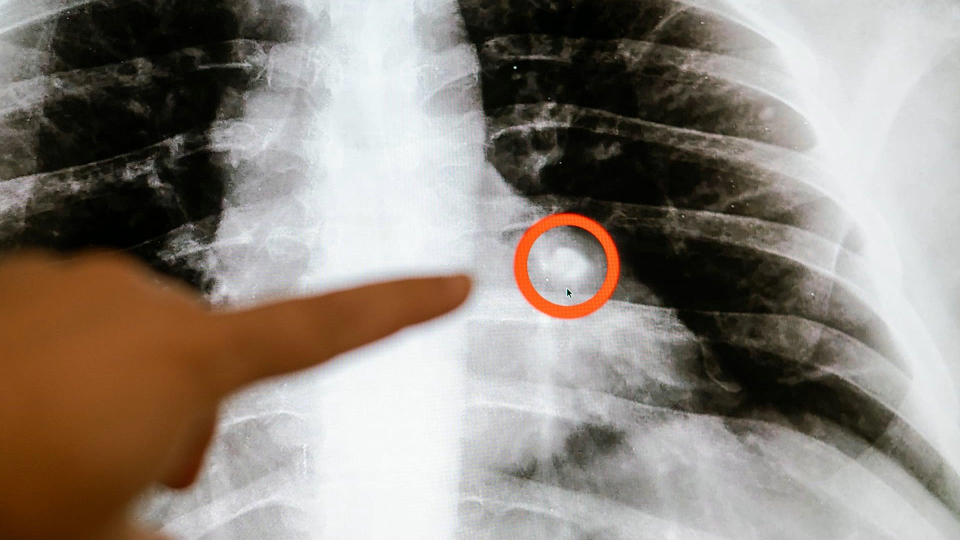 How to prevent the leading cause of cancer deaths