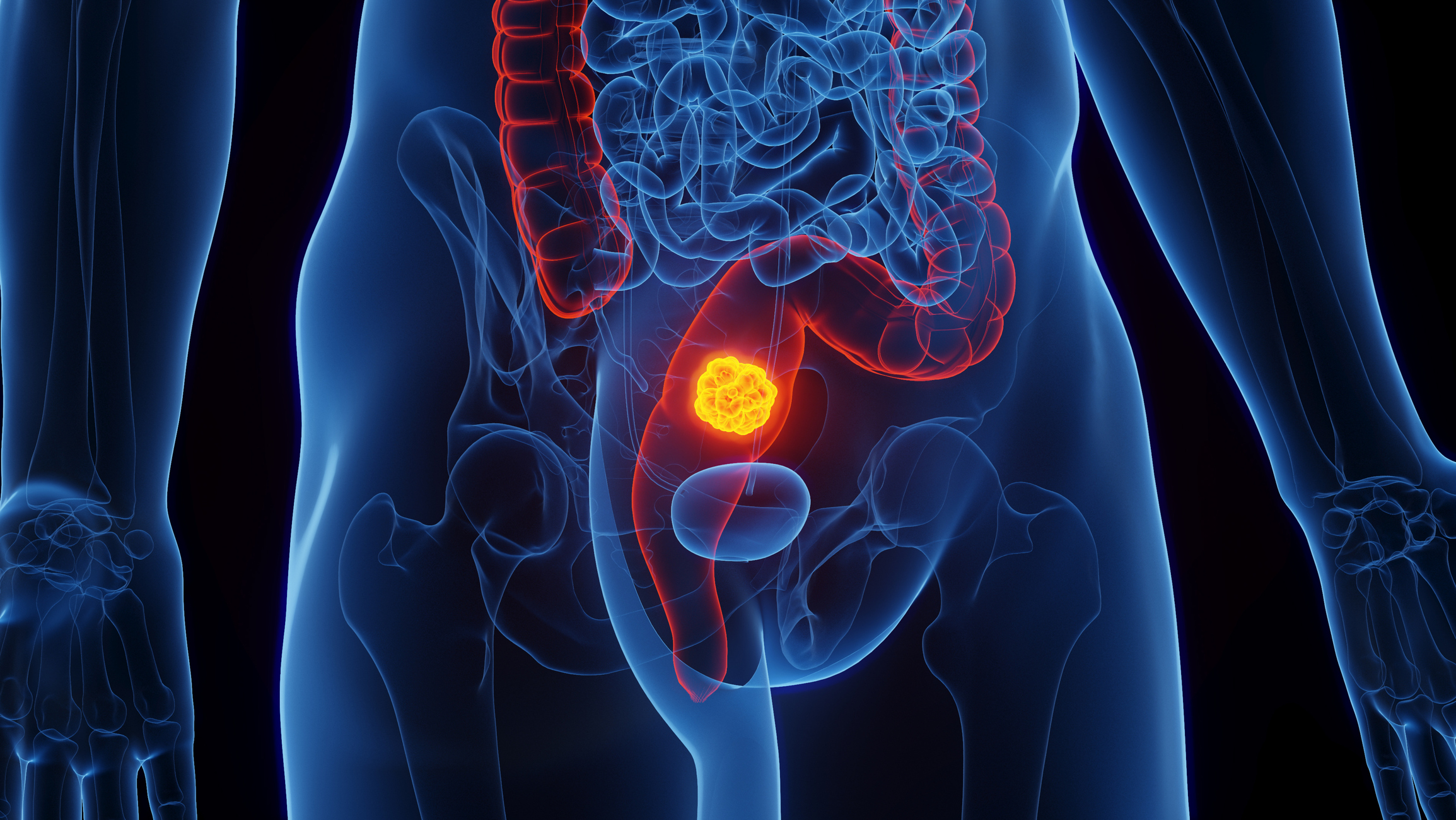 Some rectal cancer patients may be able to skip surgery, chemo, and ...