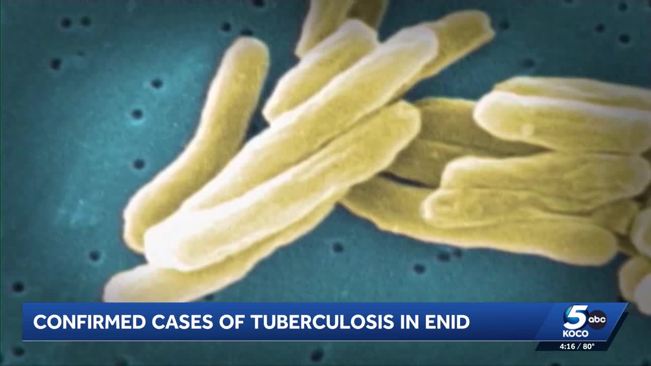 Tuberculosis cases raise concerns at Enid Public Schools: How common is it?