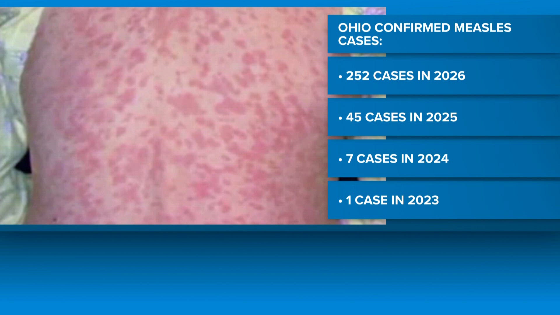 Medina County confirms 3 new measles cases