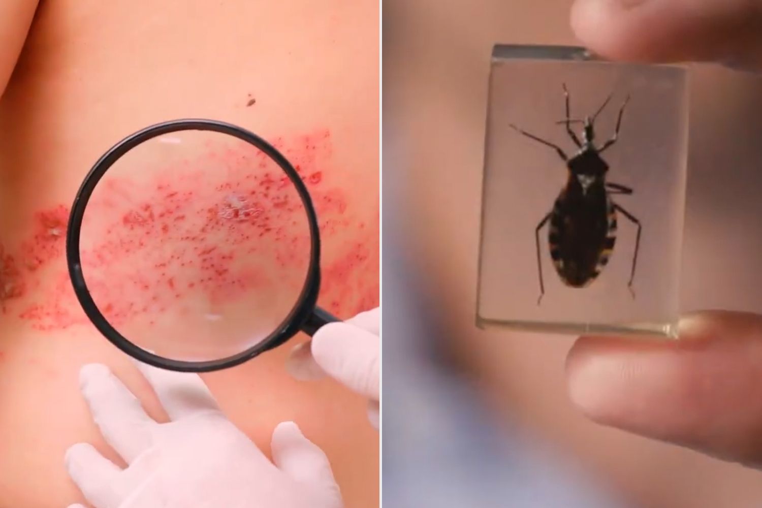 Monsters Inside Me follows patients with parasites, worms and more: 'A ...