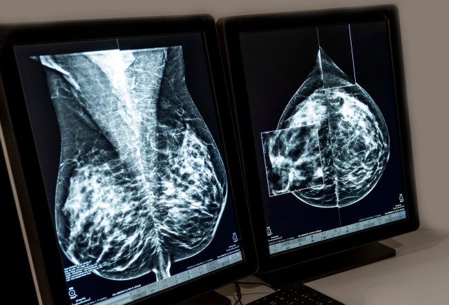 6 breast cancer innovations changing the face of disease
