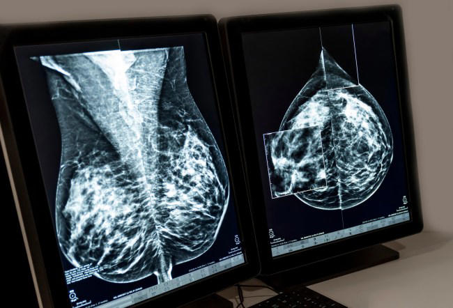 6 breast cancer innovations changing the face of disease