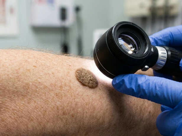 That strange skin growth? It might be seborrhoeic keratosis