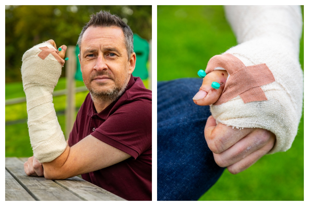 Yorkshire chef hails 'phenomenal' surgeons for reattaching severed ...