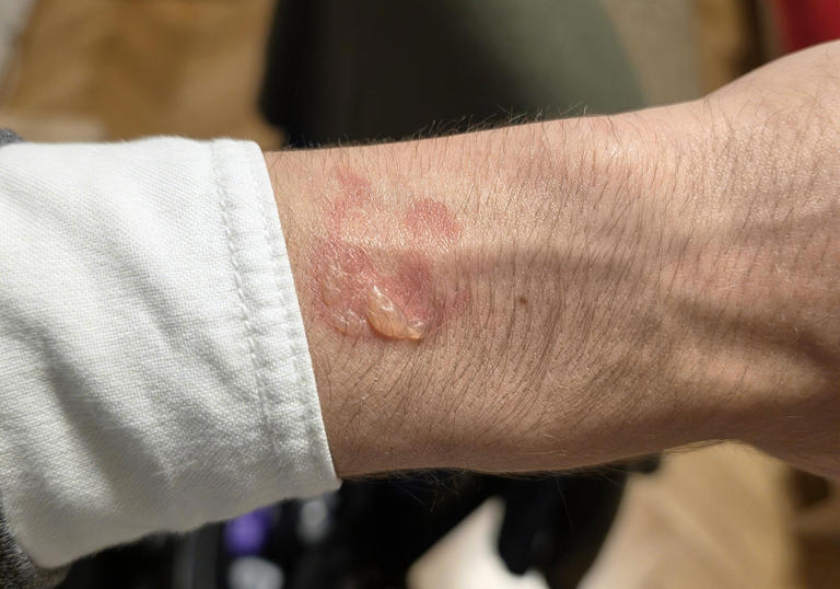 Plusieurs modèles de Galaxy Watch accusés de brûler le poignet de leurs ...