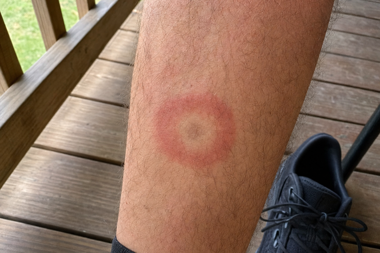 Beyond the bullseye: 12 Lyme disease symptoms the CDC says to watch for