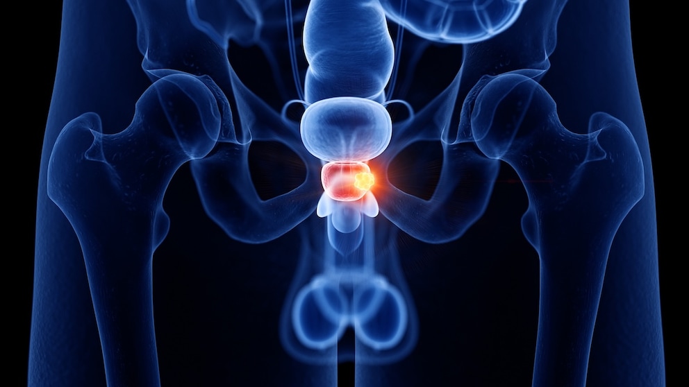 What your blood could reveal about future prostate cancer risk