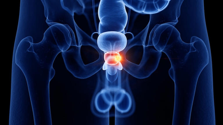 What your blood could reveal about future prostate cancer risk