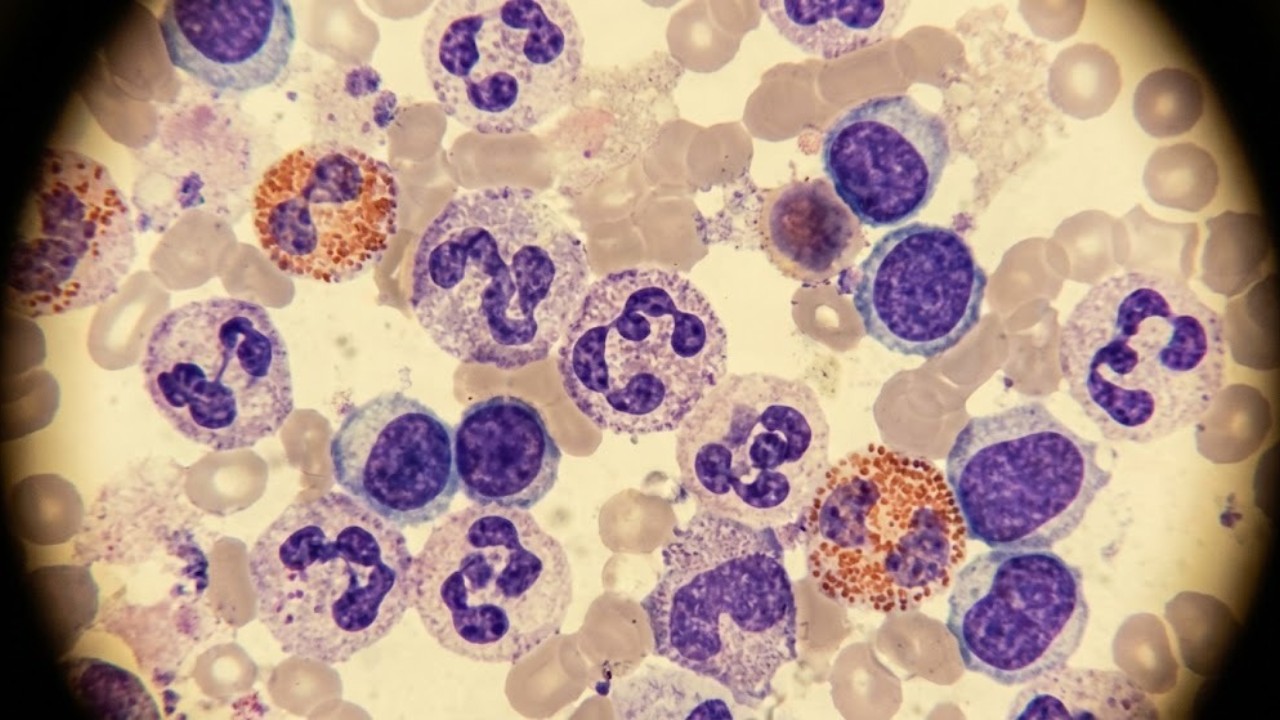 Study maps 1 million immune cells to disease risk