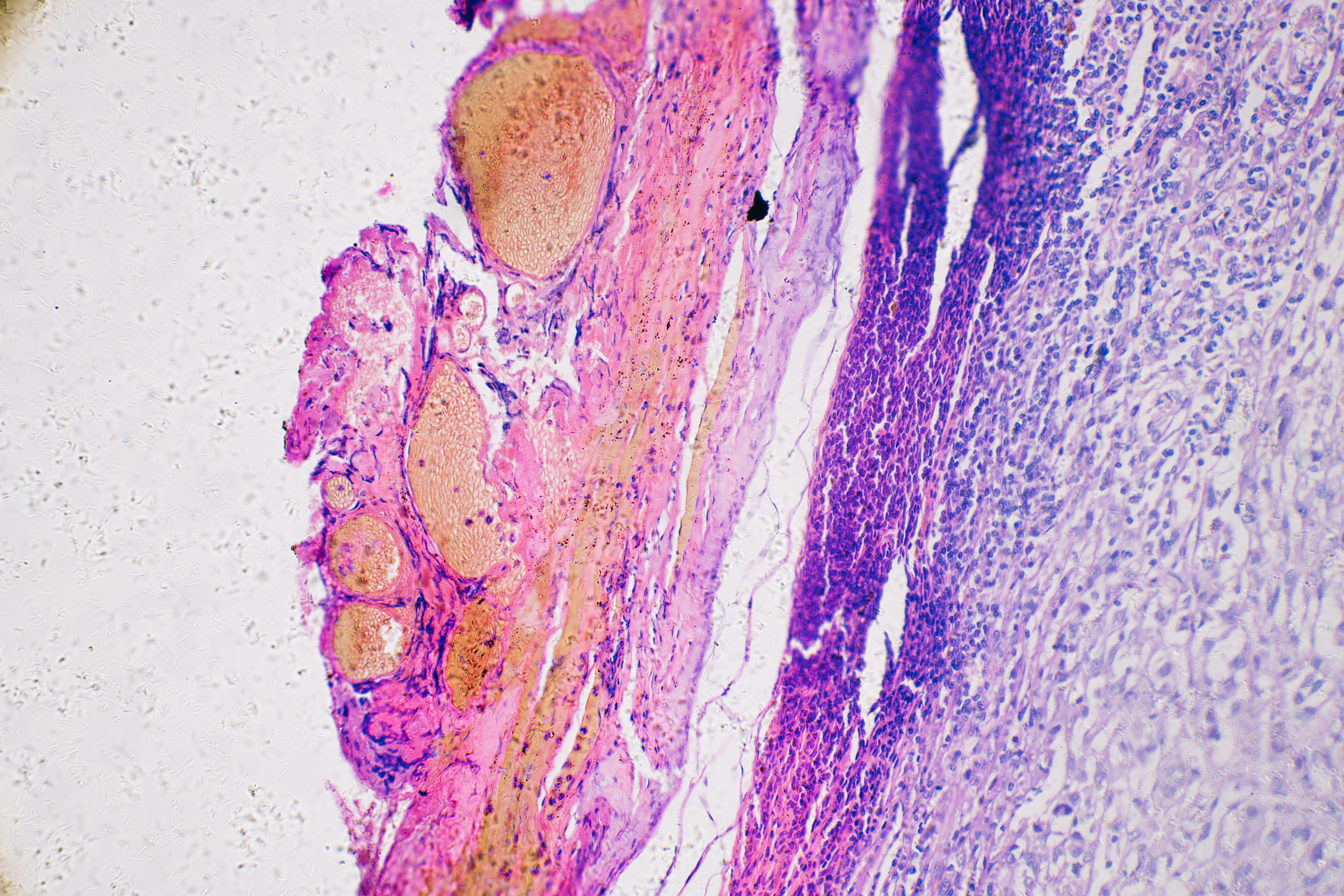 A personalized cancer vaccine lowers melanoma recurrence by 42%