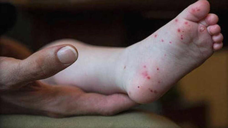 Crutcho Elementary reports hand, foot and mouth disease outbreak