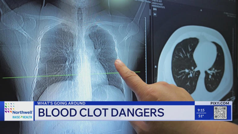 What's going around: Blood clot dangers