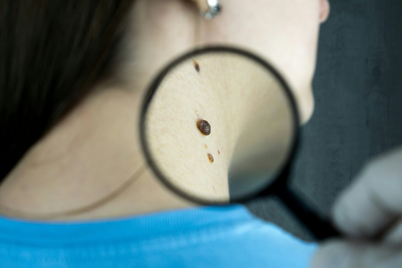 Melanoma vaccine reduces death or cancer recurrence by 42%