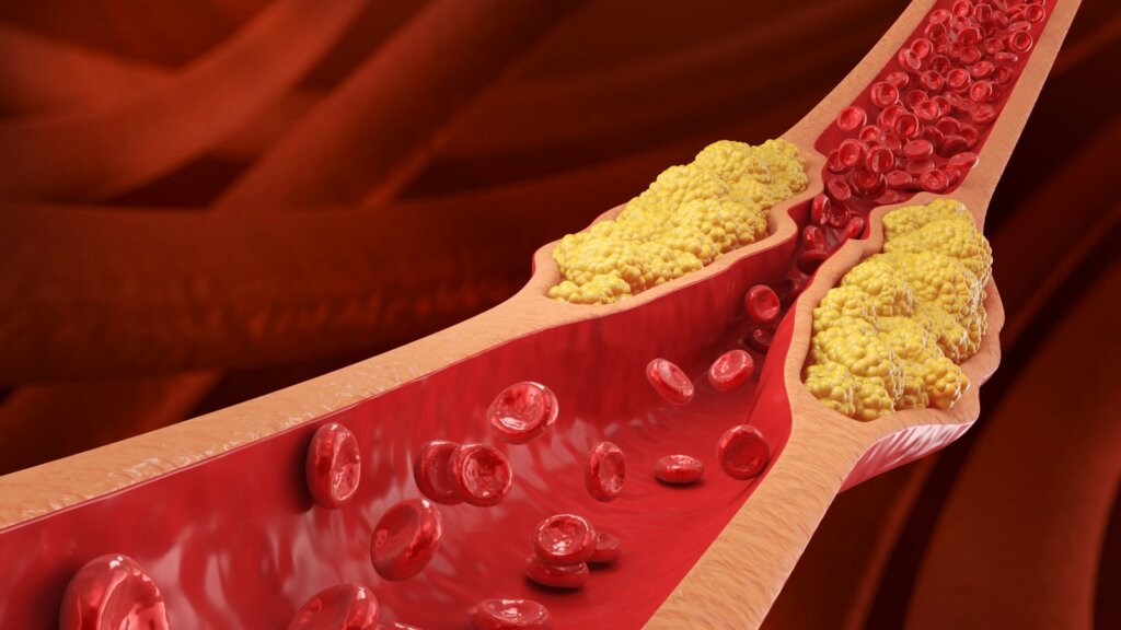 A cardiologist explains what people get wrong about high cholesterol