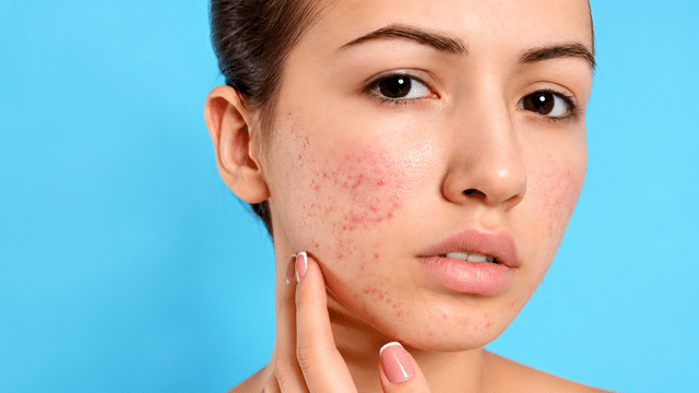 Why does your skin break out in winter? Dermatologist shares prevention ...