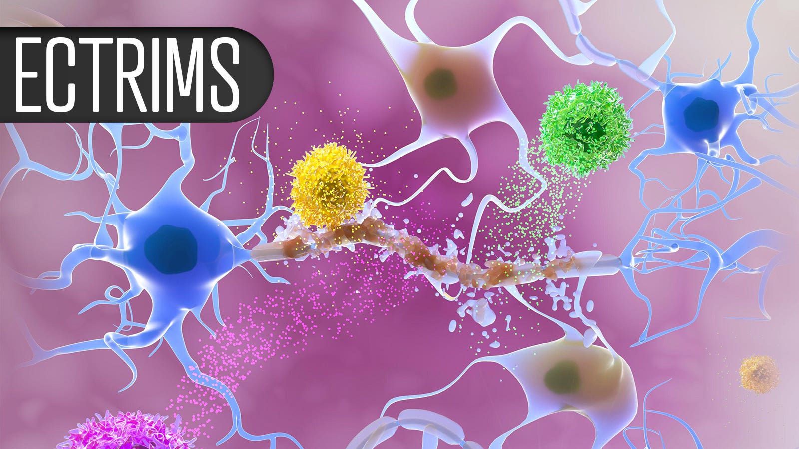 Multiple sclerosis anti-CD20 drug linked to bowel disease risk