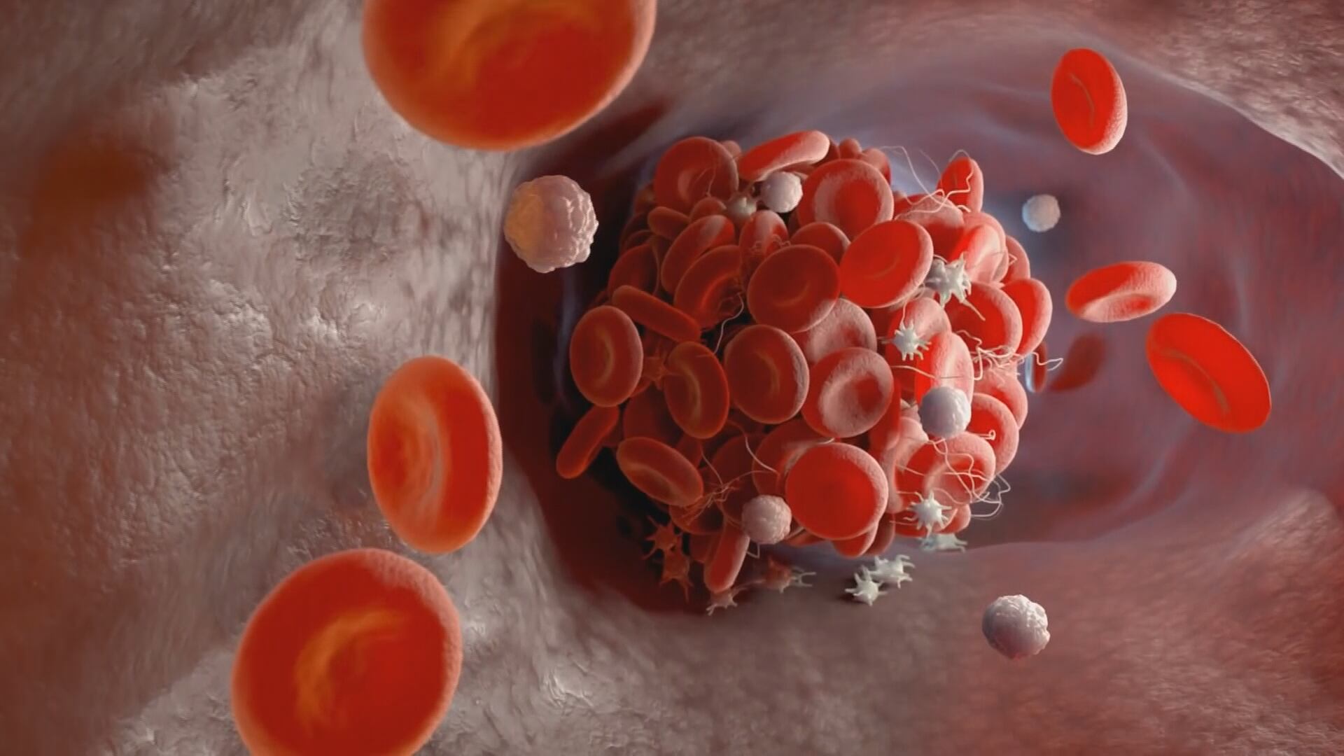 Recognizing the danger of blood clots