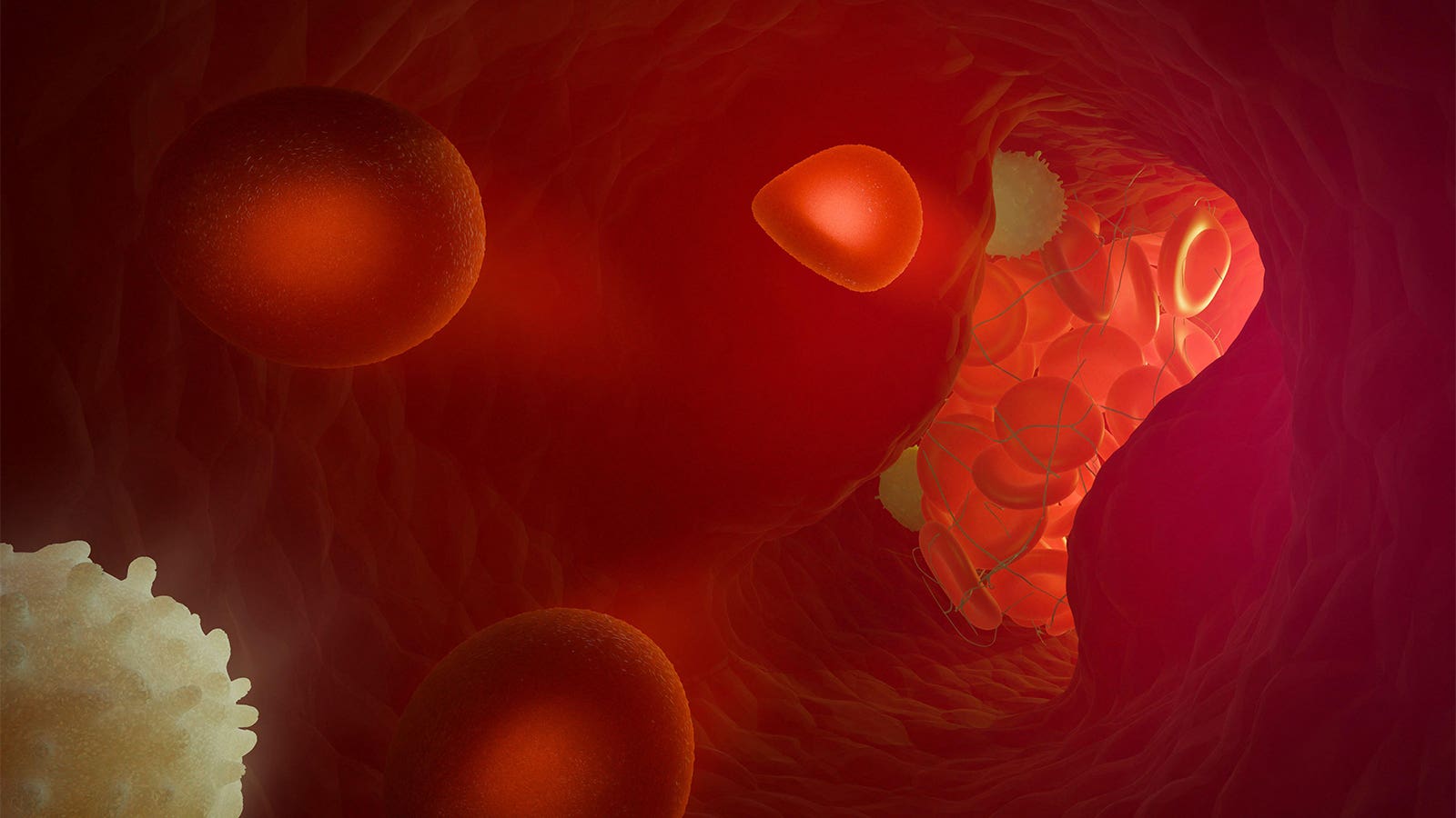 Endovascular therapy eyed for milder strokes, later time window