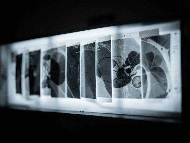 What radiation from repeated CT scans adds up to over a lifetime