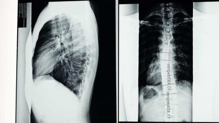 Scientists question Russia’s reported spinal cord transplant. Can the ...