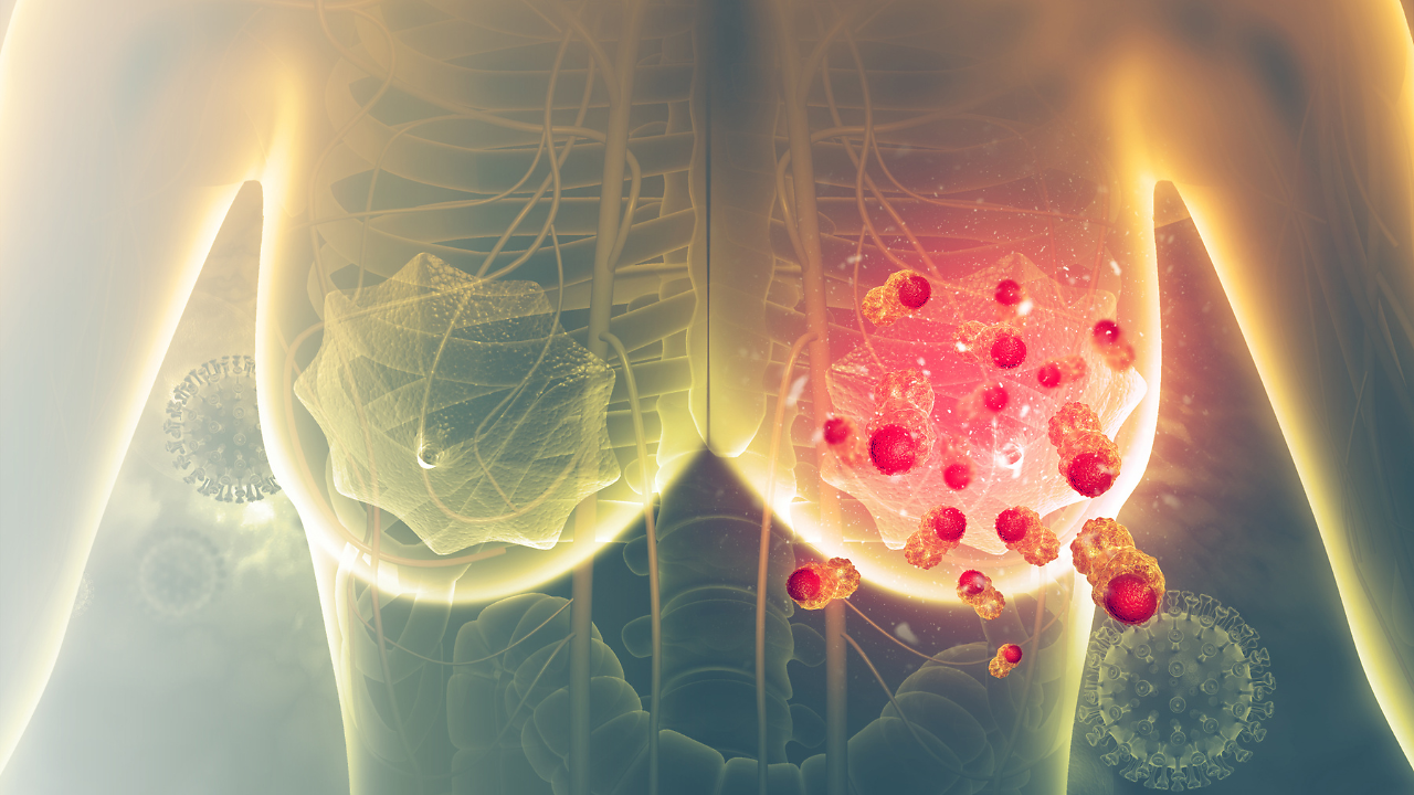 Beyond the lump: Overlooked breast cancer symptoms that can delay diagnosis